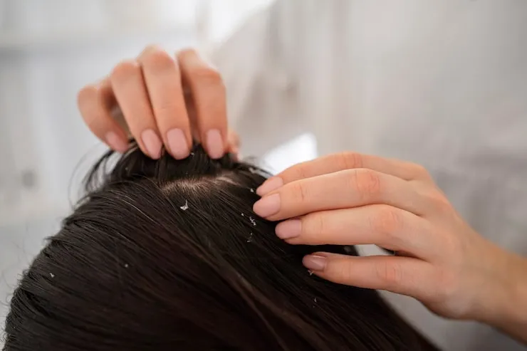 Permanent Dandruff Solutions