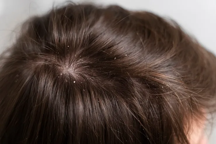 What Causes Dandruff and Why It Keeps Coming Back