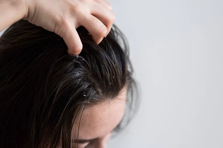 How to Reduce Dandruff Permanently