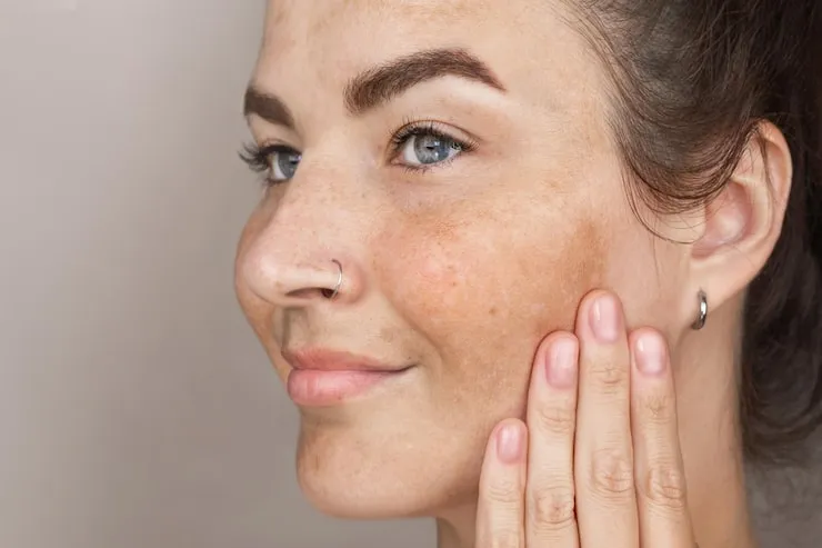 Understanding Your Skin and Dark Spots