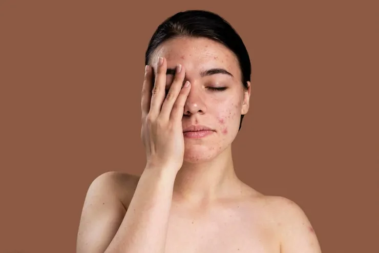 Skincare Products to Avoid If You Have Acne