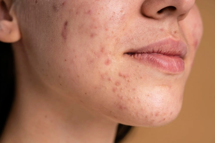 Why Go Minimalist for Acne-Prone Skin