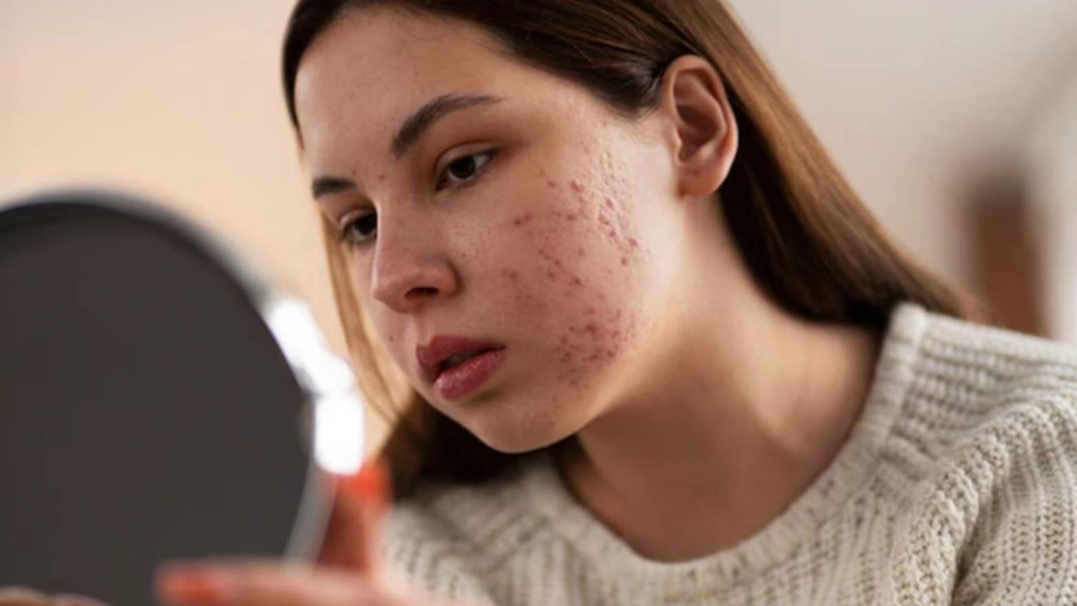 Understanding Your Acne Type