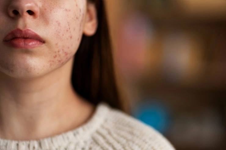 What Makes Skin Both Sensitive And Prone To Acne